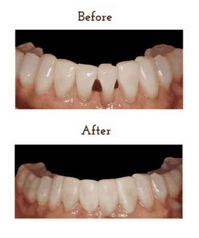Before and After cosmetic bonding