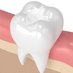 Tooth colored fillings