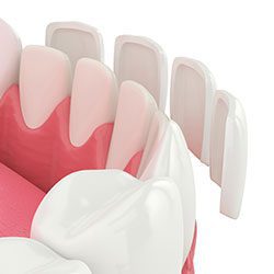 Porcelain veneers