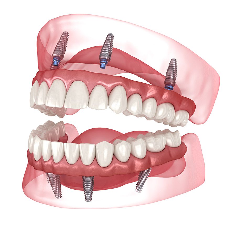 Implant-Supported Dentures (All-On-4)
