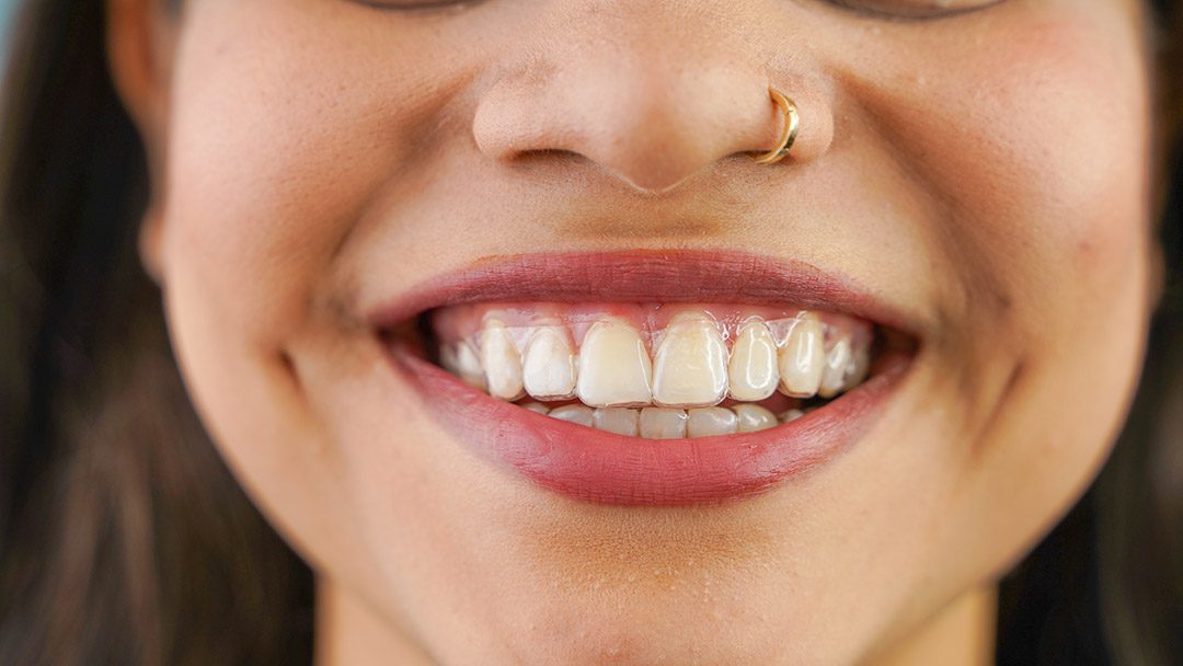 Close-up of a smiling patient wearing clear Invisalign aligners for discreet teeth straightening treatment.