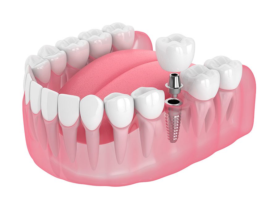 Single Unit Implants